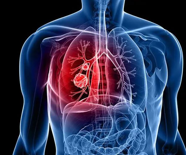Respiratory Diseases Best Homeopathy Treatment in Baner, Pune